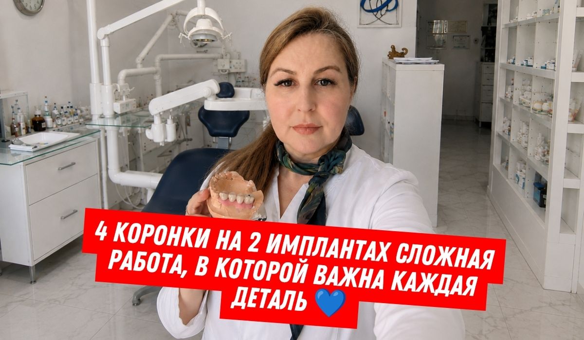 4 коронки на 2 имплантах: сложное протезирование при узком костном гребне 4 коронки на 2 имплантах: сложное протезирование при узком костном гребне