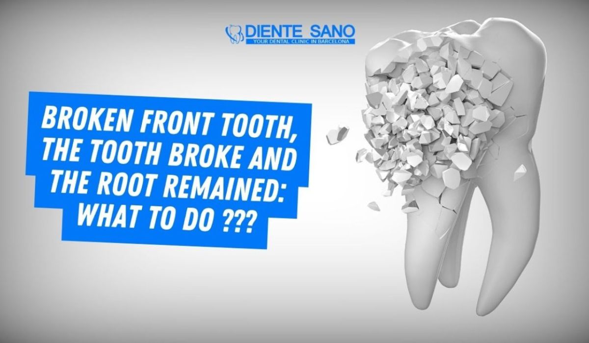 Broken front tooth, a tooth has broken and the root remains: what to do ?