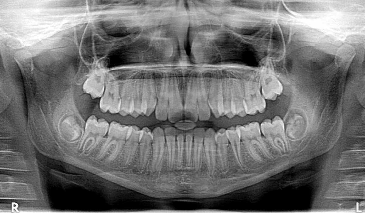 Ортопантомограмма кариес