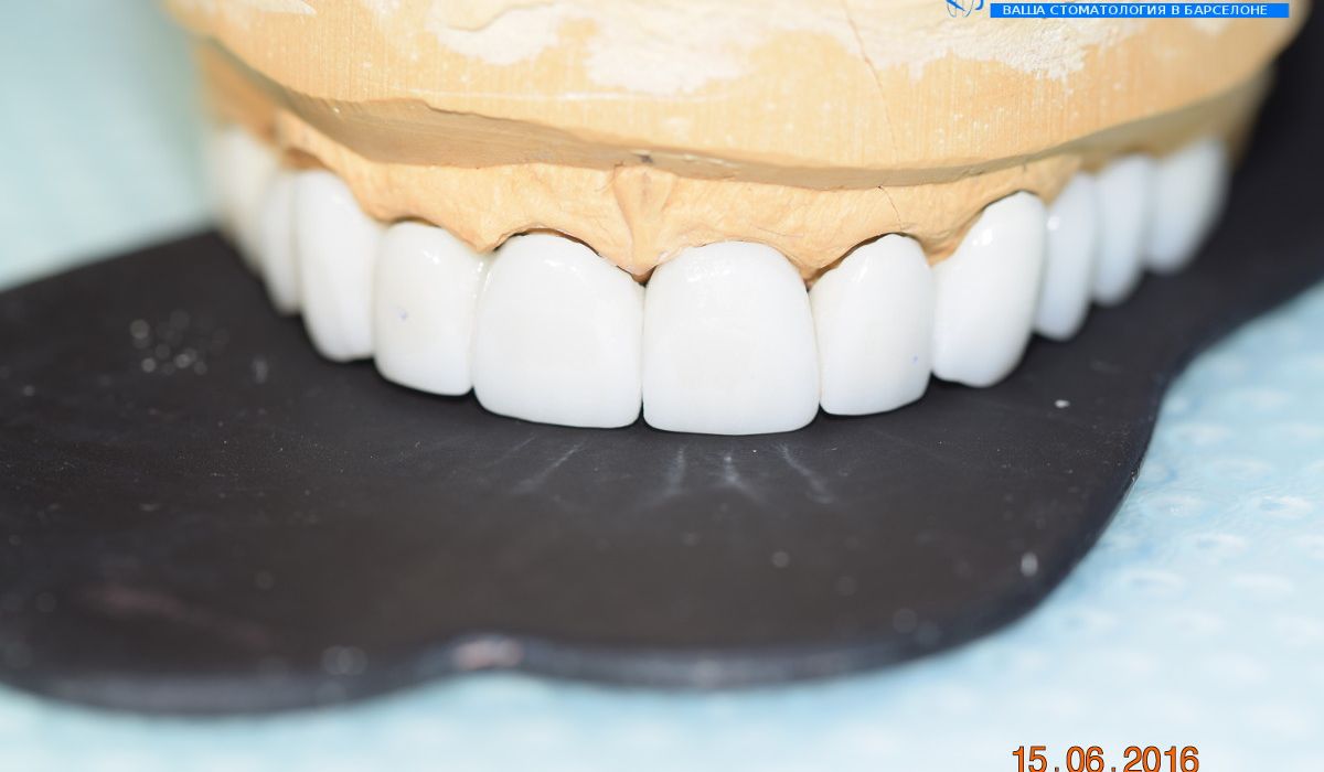 Реабилитация зубных рядов зубных рядов