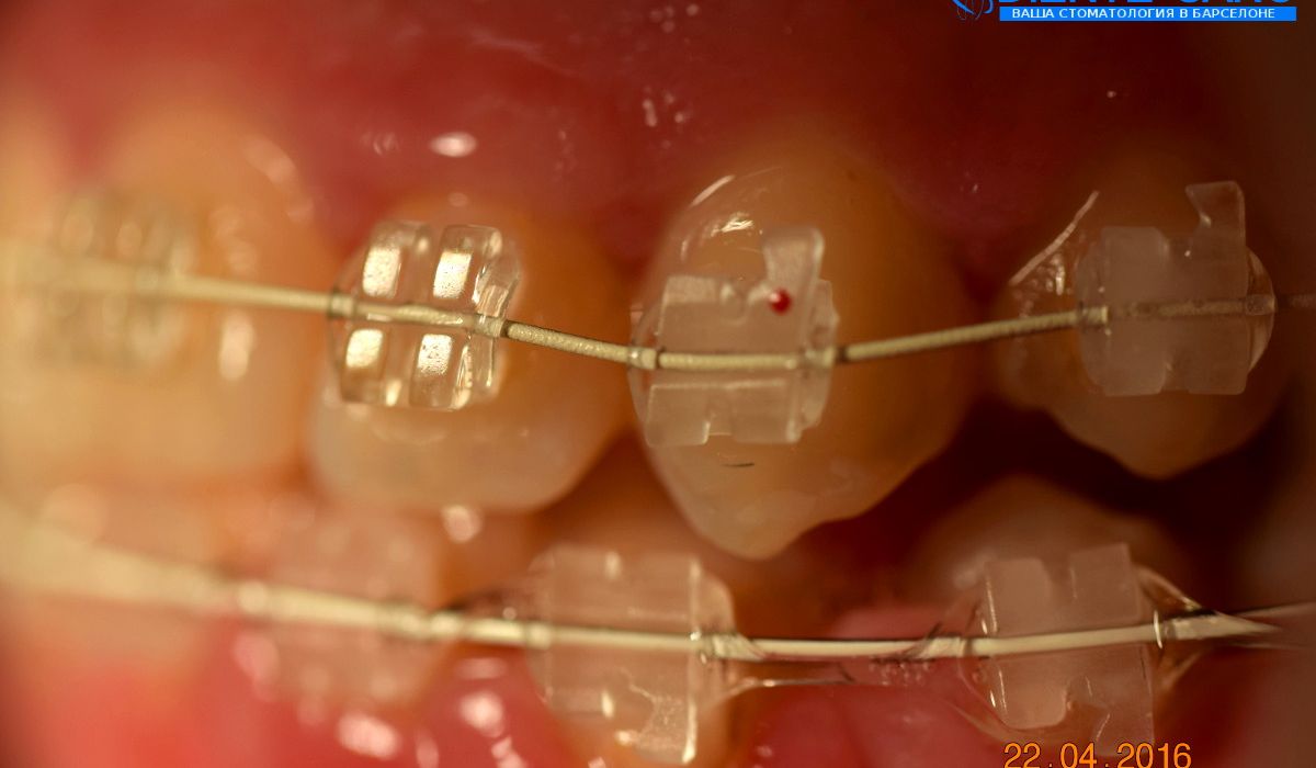 Orthodontics in Barcelona