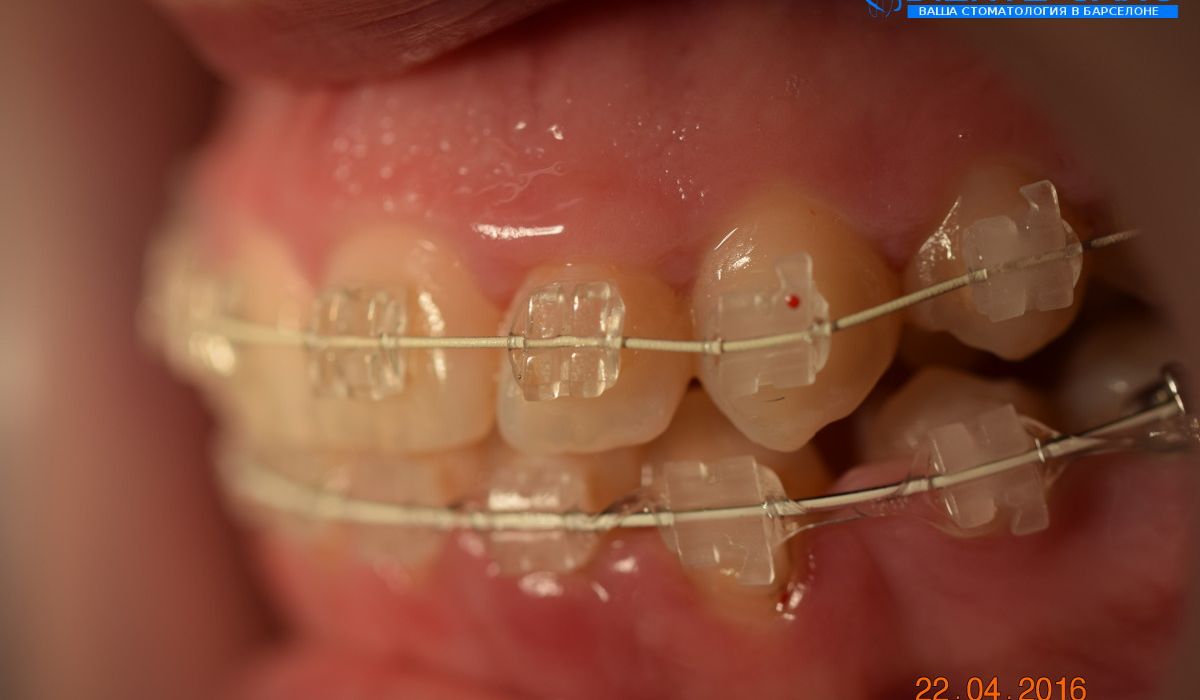 Orthodontics in Barcelona