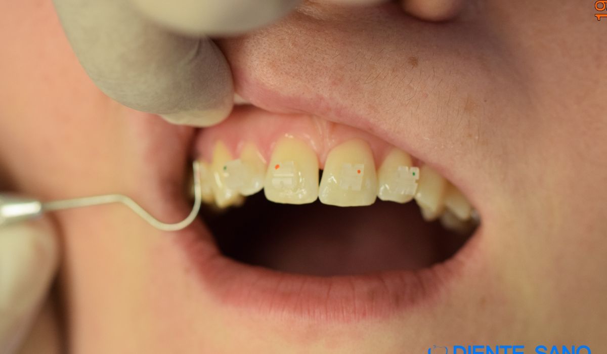 Orthodontics in Barcelona