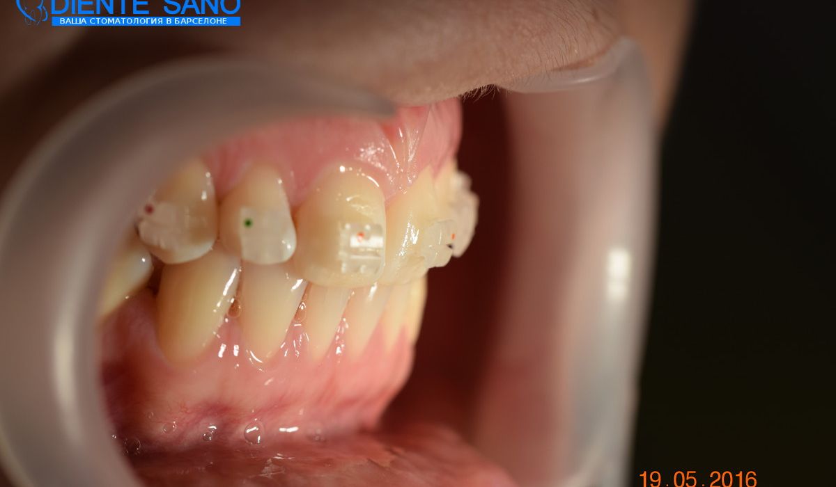 Orthodontics in Barcelona Orthodontics in Barcelona