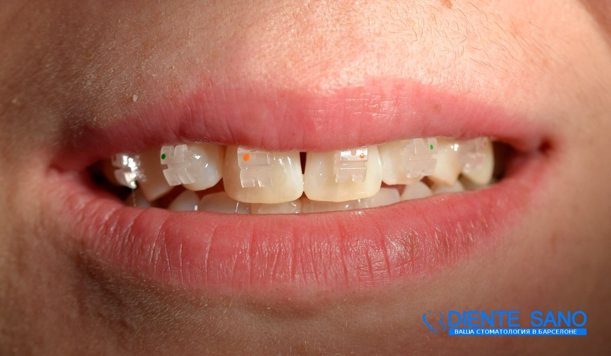 Orthodontics in Barcelona