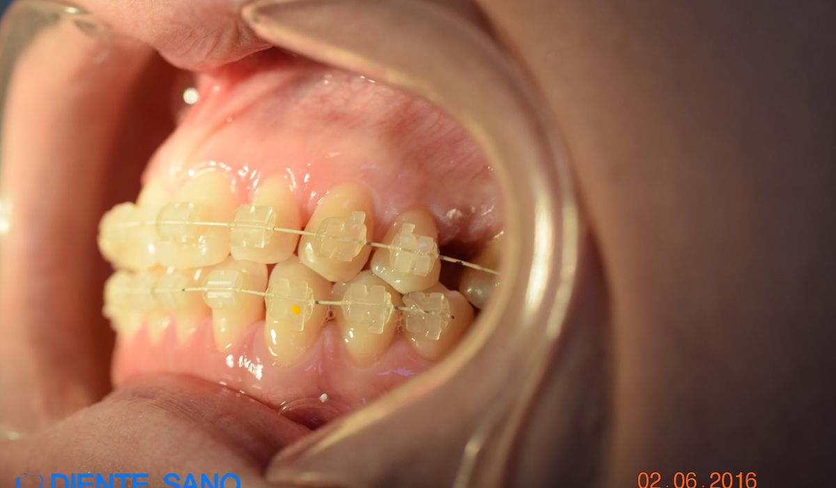 Orthodontics in Barcelona Orthodontics in Barcelona