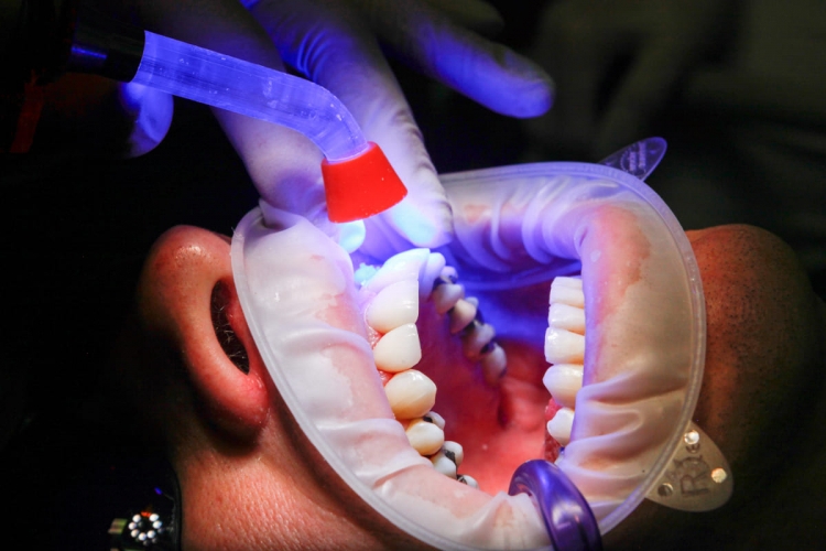 7 мифов о здоровье зубов. Не зря стоматологи до последнего стараются сохранить нерв, продлевая зубу жизнь. Стоматологическая клиника в Барселоне