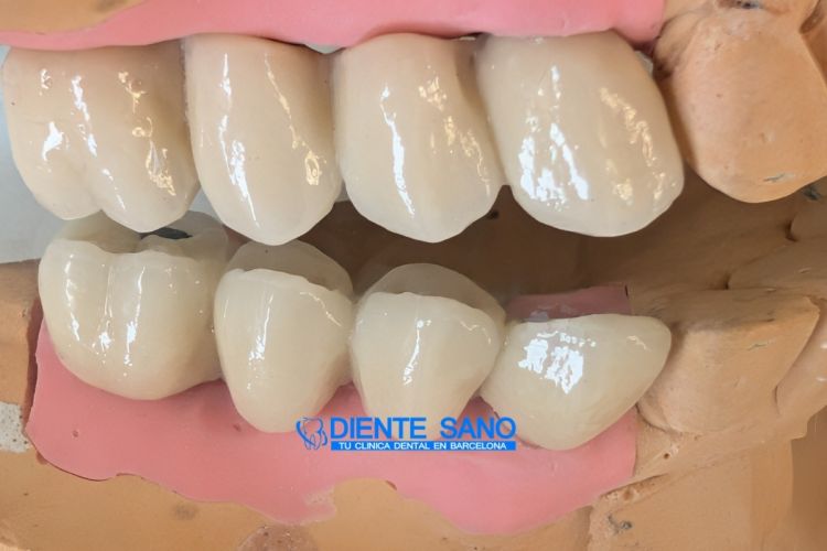 4 coronas sobre 2 implantes: rehabilitación protésica compleja con cresta ósea estrecha