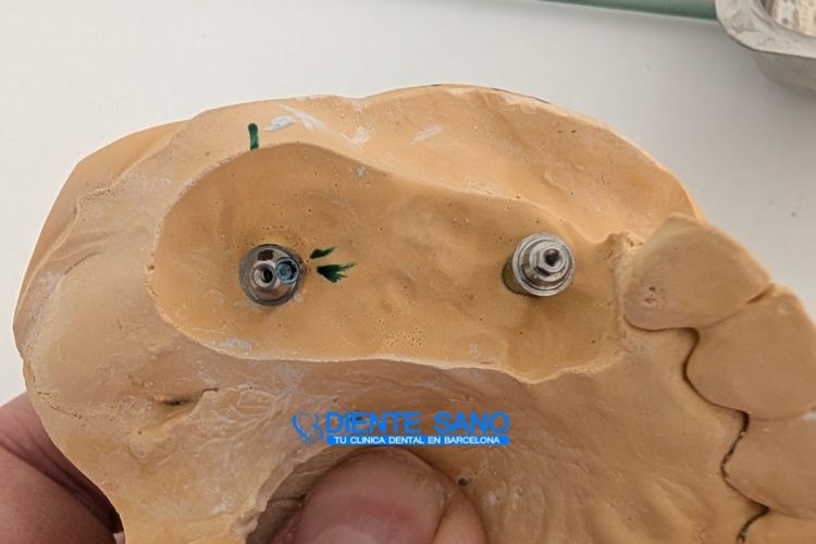 4 coronas sobre 2 implantes: rehabilitación protésica compleja con cresta ósea estrecha