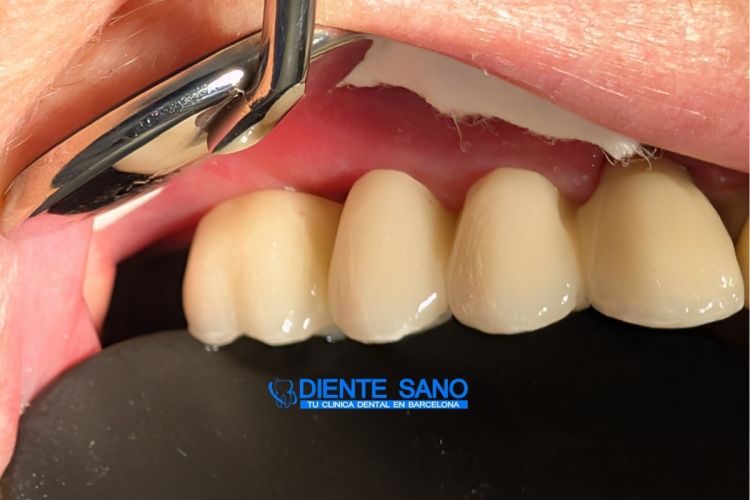 4 coronas sobre 2 implantes: rehabilitación protésica compleja con cresta ósea estrecha