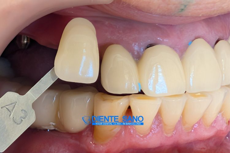 4 Crowns on 2 Implants: Complex Prosthetic Treatment with a Narrow Alveolar Ridge