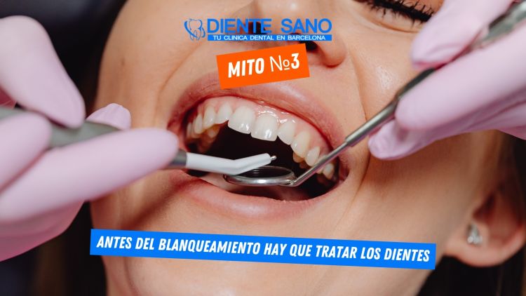 Blanqueamiento dental en Barcelona: mitos y realidades