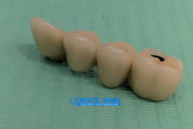 4 Crowns on 2 Implants: Complex Prosthetic Treatment with a Narrow Alveolar Ridge