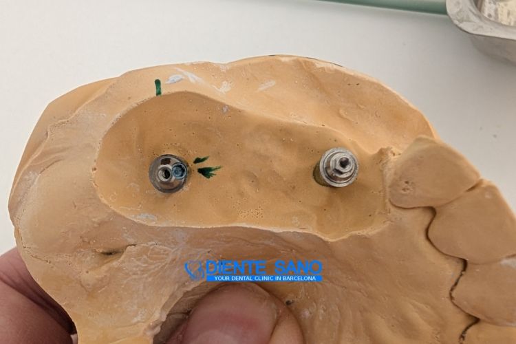 4 Crowns on 2 Implants: Complex Prosthetic Treatment with a Narrow Alveolar Ridge