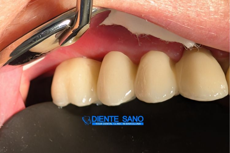 4 Crowns on 2 Implants: Complex Prosthetic Treatment with a Narrow Alveolar Ridge