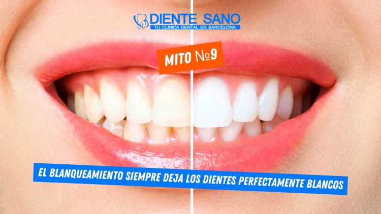 Blanqueamiento dental en Barcelona: mitos y realidades