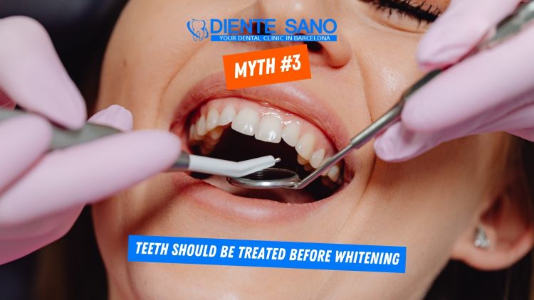 Teeth Whitening in Barcelona: Myths and Facts