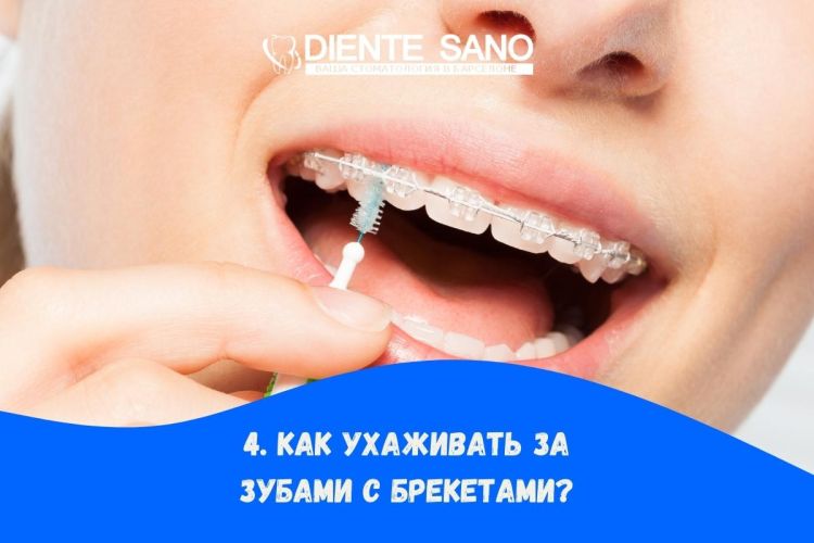 Часто задаваемые вопросы о брекетах: все, что вам нужно знать. Как ухаживать за зубами с брекетами?