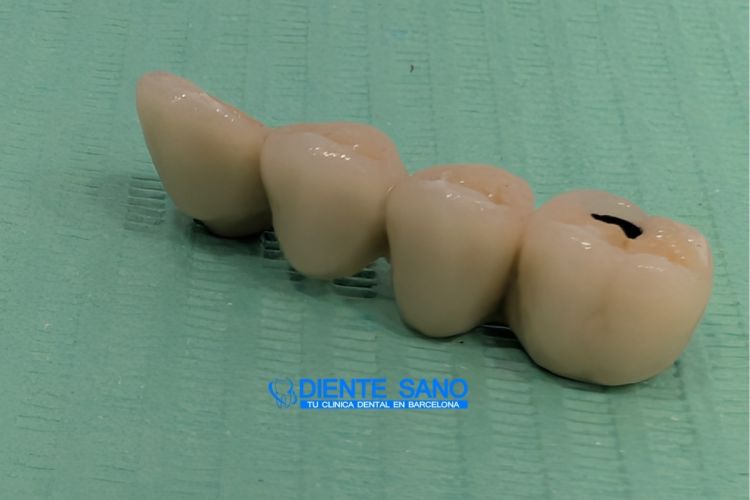4 coronas sobre 2 implantes: rehabilitación protésica compleja con cresta ósea estrecha